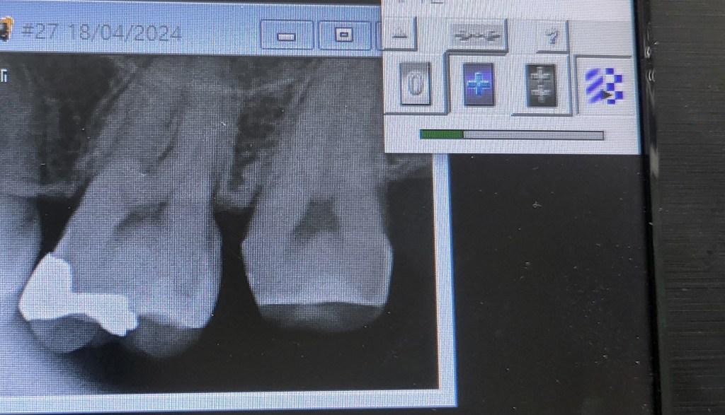 My tooth is getting a&nbsp;crown..